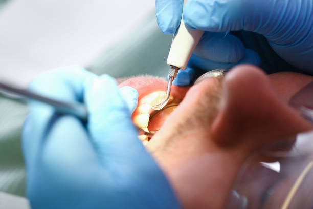 Best Emergency Tooth Extraction in Mcelhattan, PA